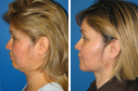 Before & After Photos